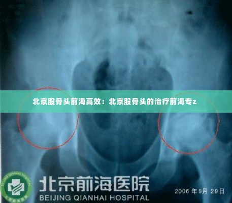 北京股骨头前海高效：北京股骨头的治疗前海专z 