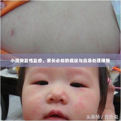 小孩突发性发疹，家长必知的症状与应急处理措施