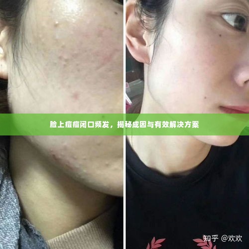 脸上痘痘闭口频发，揭秘成因与有效解决方案
